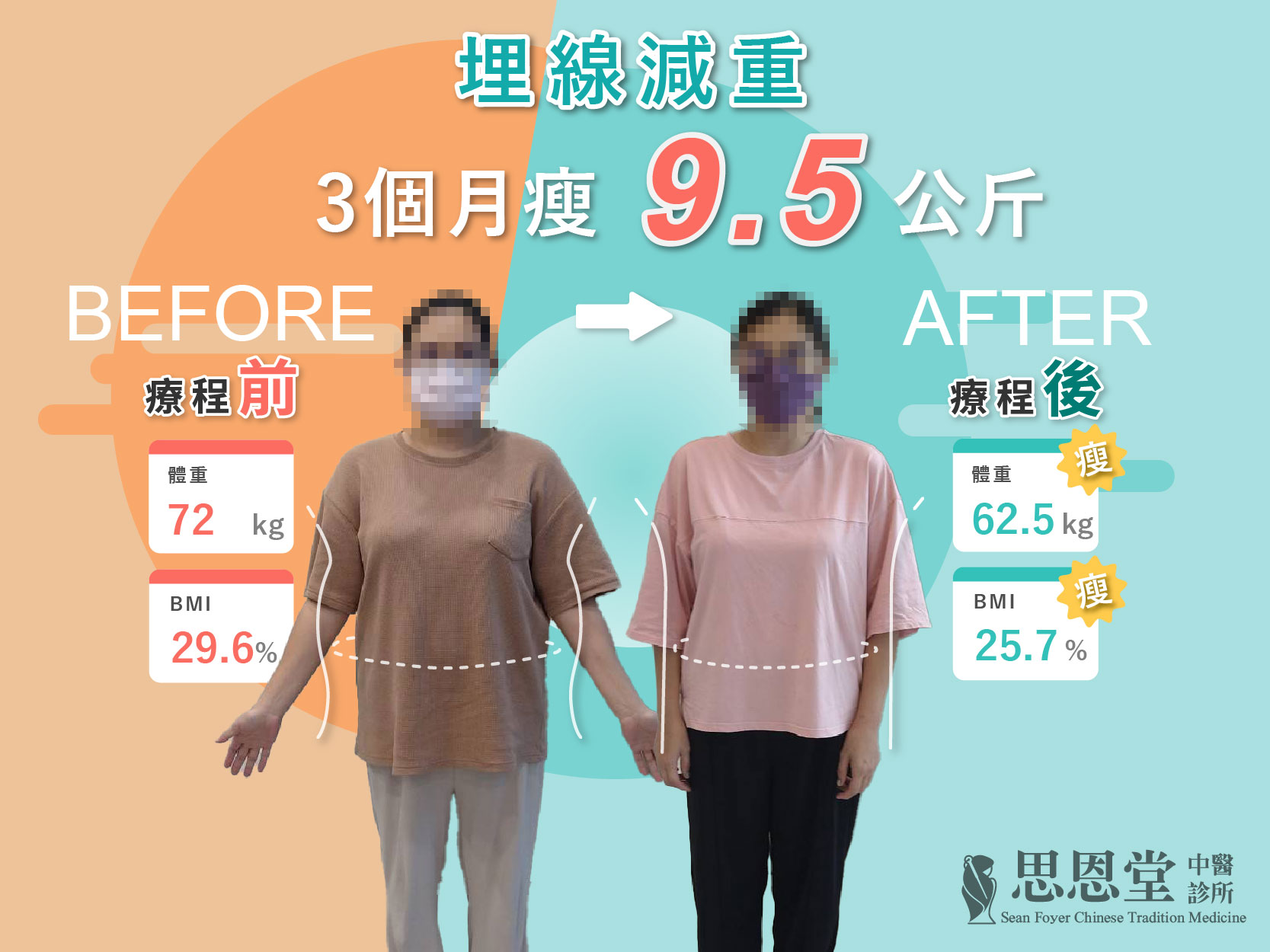 埋線減重案例 03，3個月紀錄，療程前72公斤、療程後62.5公斤，原圖保留臉部遮蔽